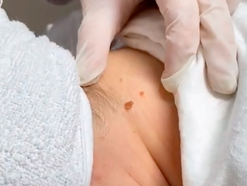 Процедура удаления новообразований фото