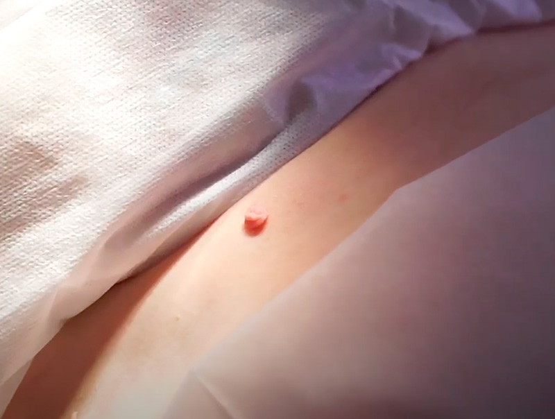 Процедура удаления новообразований фото 