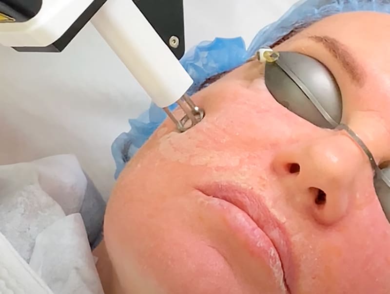 Процедура лазерного омоложения RecoSMA лица фото 