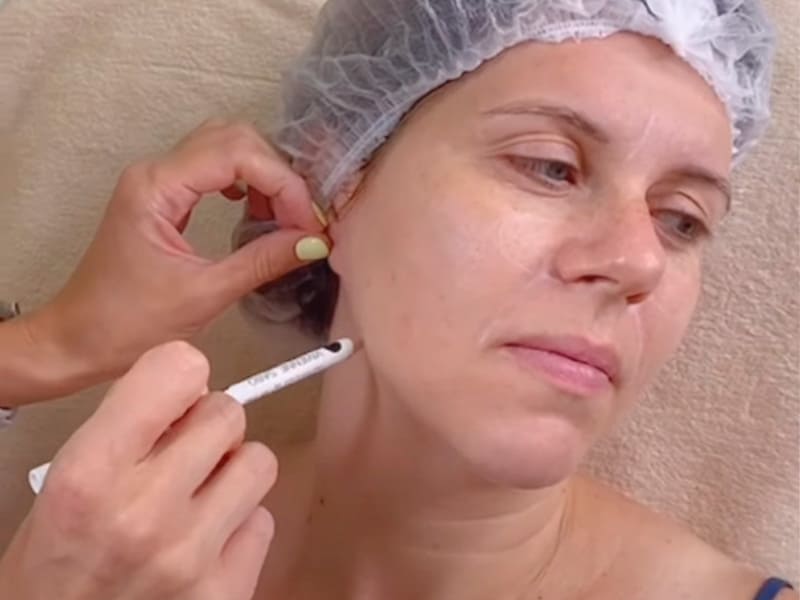 Процедура контурной пластики уколы гиалуроновой кислоты фото