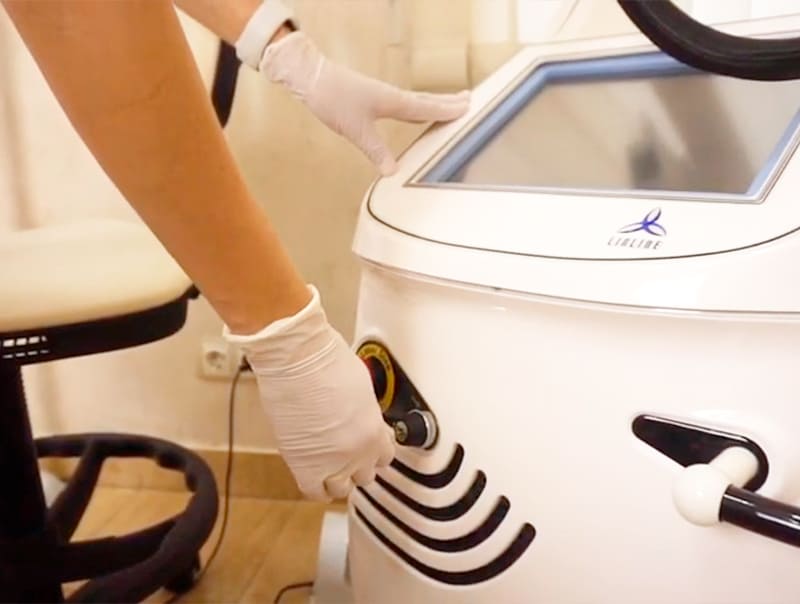 Процедура удаления рубцов RecoSMA фото