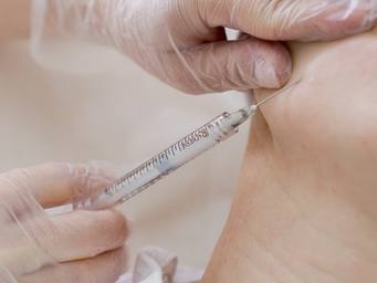 Векторный лифтинг Radiesse