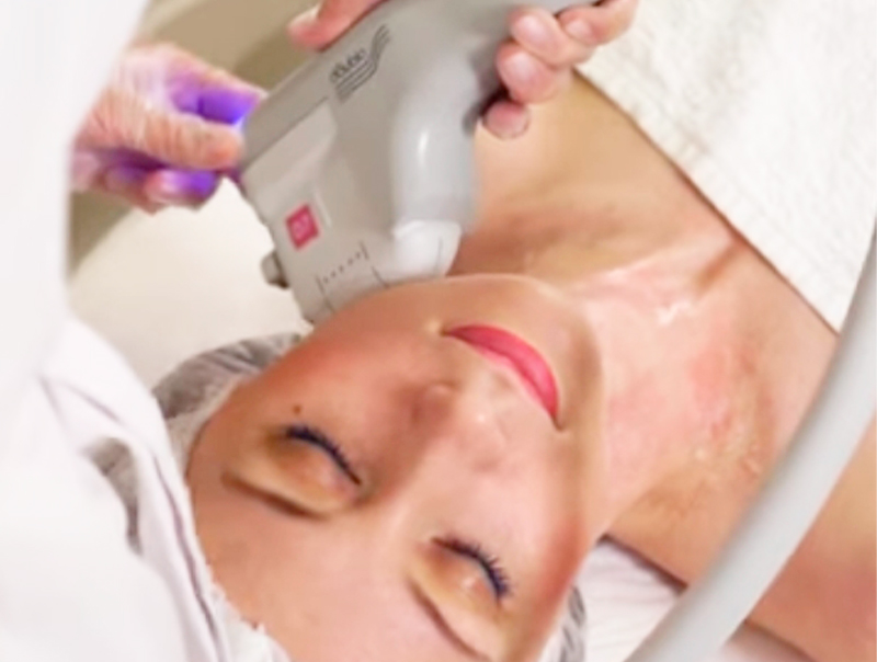 Процедура SMAS лифтинга тело фото