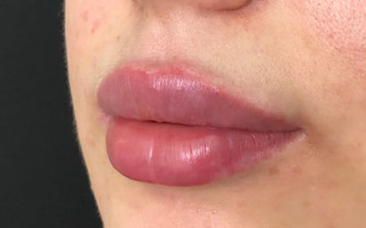 Коррекция губ с ятрогенными осложнениями.