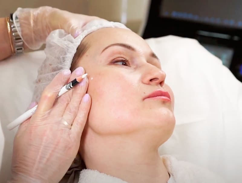 Процедура тредлифтинга фото 