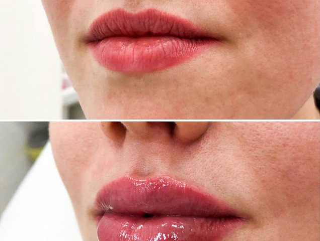 Процедура увеличения губ (аугментации губ) фото 1