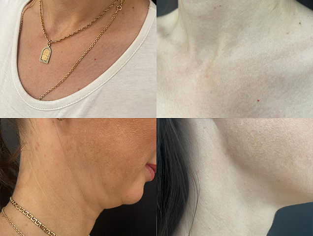 Процедура SMAS лифтинга лица фото 2