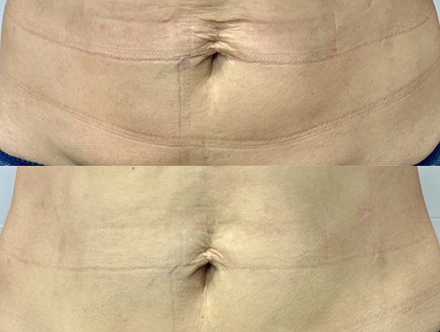 Процедура SMAS лифтинга тело фото 1