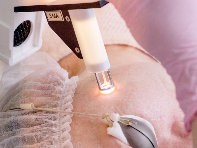 Процедура омоложения кожи стрии RecoSMA фото 4