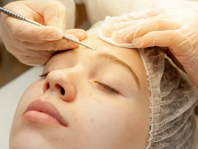 Процедура лечения и коррекции проблемной кожи фото 1 Процедура лечения и коррекции проблемной кожи фото 1