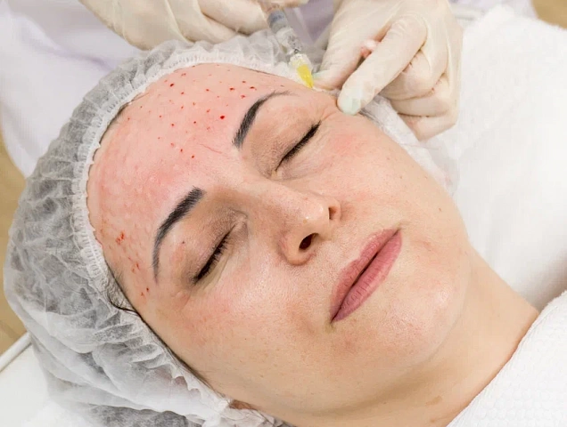 Процедура биоревитализации фото 1