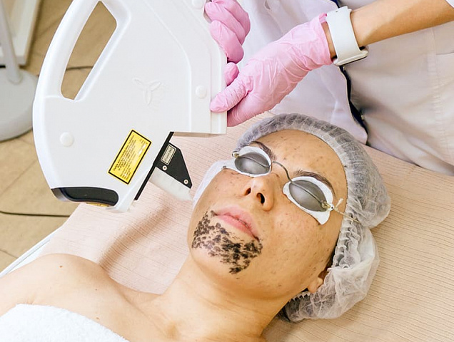 Процедура карбонового пилинга фото 3