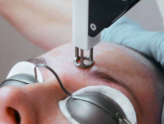 Процедура лазерной наноперфорации кожи омоложение кожи, стрии фото 3