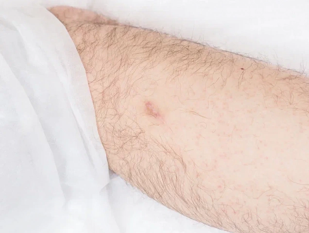 Процедура удаления рубцов RecoSMA фото 2