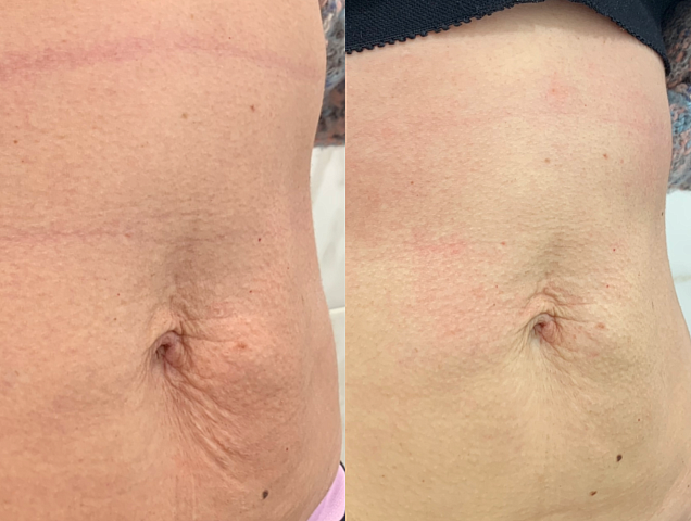 Процедура SMAS лифтинга тело фото 2