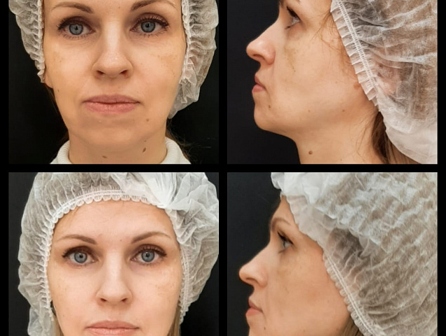 Процедура SMAS лифтинга лица фото 1