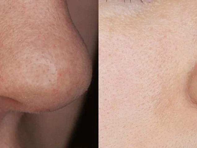 Процедура коррекции и удаления купероза фото 3