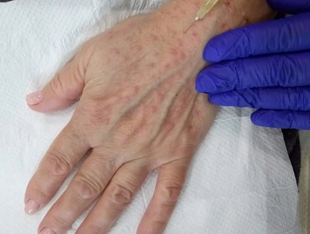 Процедура биоревитализации рук фото Процедура биоревитализации рук фото