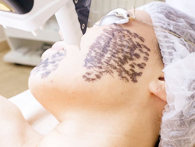 Процедура карбонового пилинга фото 2