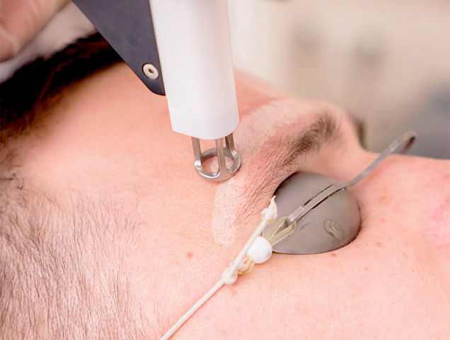 Процедура лазерного омоложения RecoSMA лица для мужчин фото 2