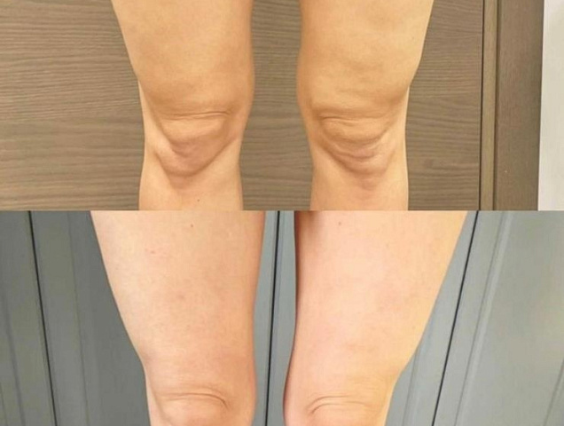 Процедура SMAS лифтинга тело фото 3