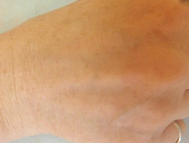 Процедура лазерного омоложения RecoSMA рук фото 2