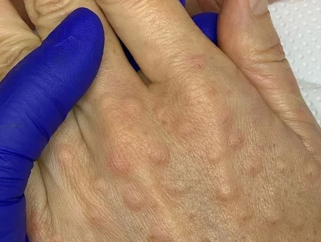 Процедура биоревитализации рук фото 1 Процедура биоревитализации рук фото 1
