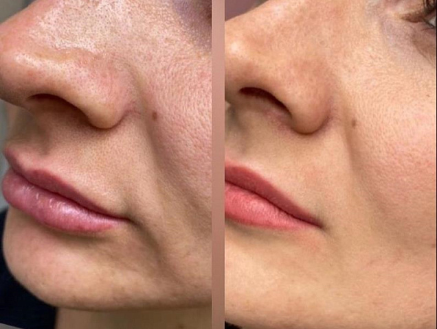 Микроигольчатый RF-лифтинг лицо фото 1