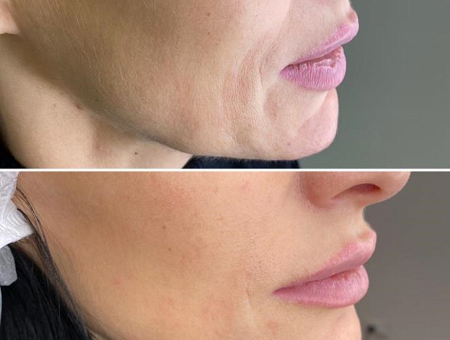 Микроигольчатый RF-лифтинг лицо фото 3