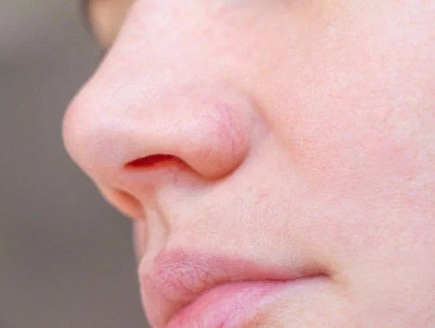 Процедура коррекции и удаления купероза фото 1