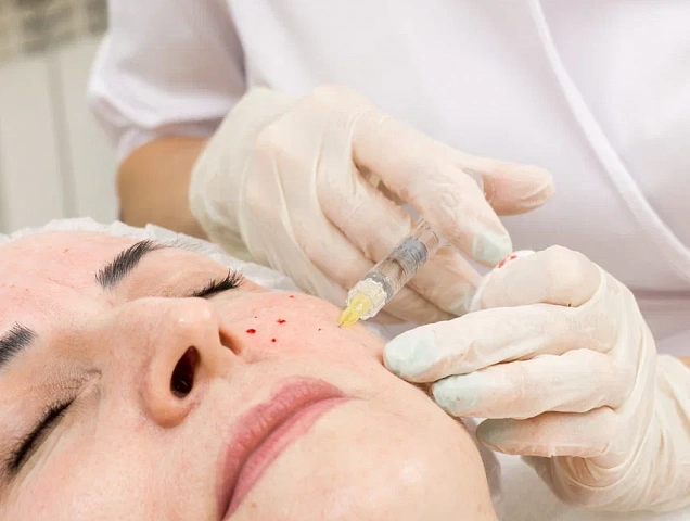 Процедура биоревитализации фото 2