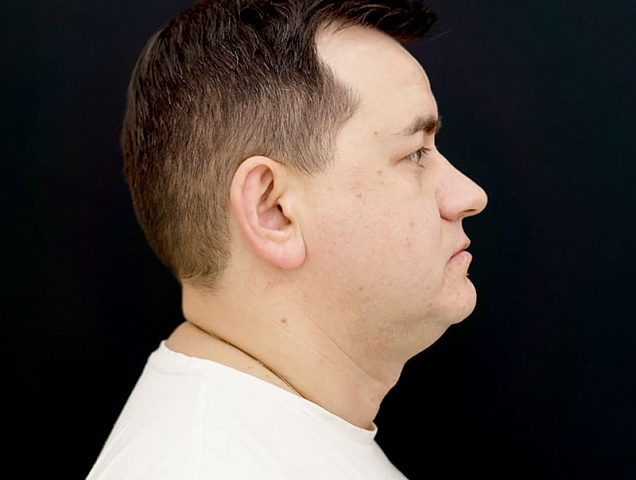 Процедура SMAS лифтинга лица для мужчин фото 2