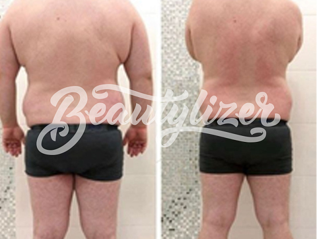 Процедура RSL-скульптурирование для мужчин фото 3 Процедура RSL-скульптурирование для мужчин фото 3