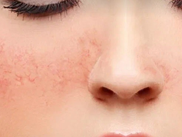 Процедура коррекции и удаления розацеа фото 1