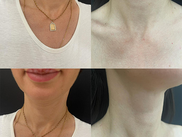 Процедура SMAS лифтинга лица фото 3