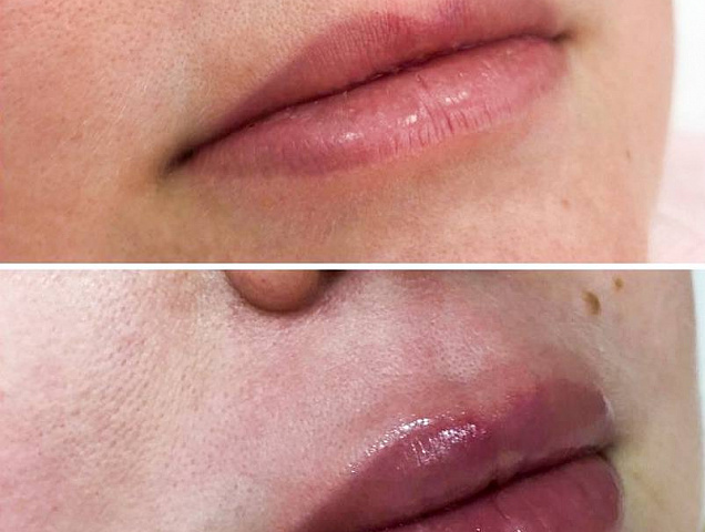Процедура увеличения губ (аугментации губ) фото 2