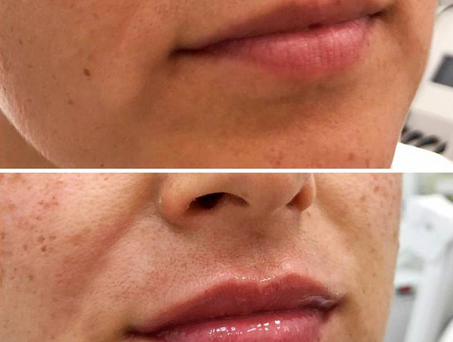 Процедура увеличения губ (аугментации губ) фото 4