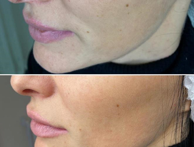 Микроигольчатый RF-лифтинг лицо фото 2
