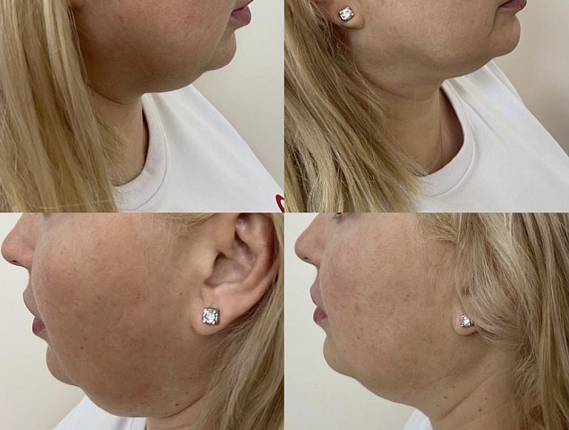 Процедура SMAS лифтинга лица фото 4