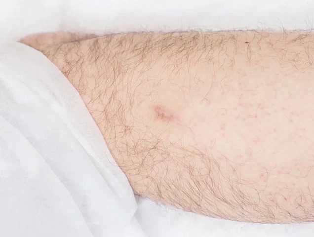 Процедура удаления рубцов RecoSMA фото 1