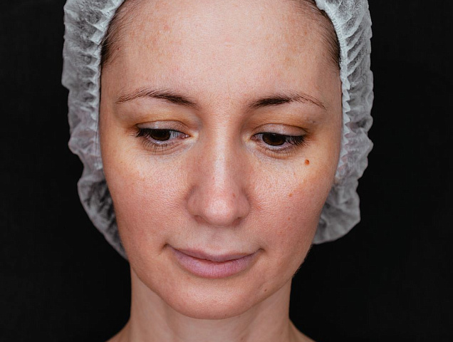 Процедура лазерной наноперфорации кожи омоложение кожи, стрии фото 2